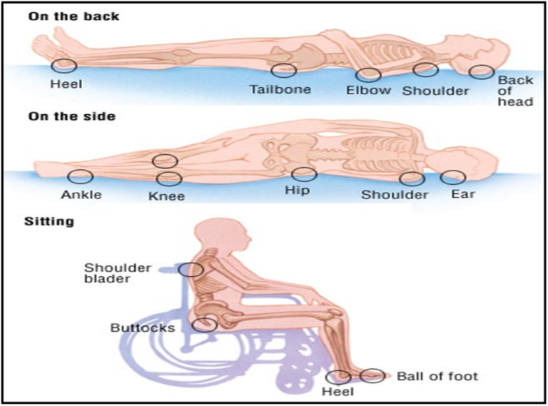 VRNS: Preventing Skin Breakdown | Surprenant & Beneski, PC